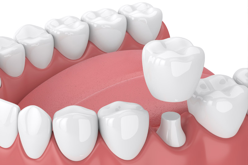 Dental Crowns in Los Angeles