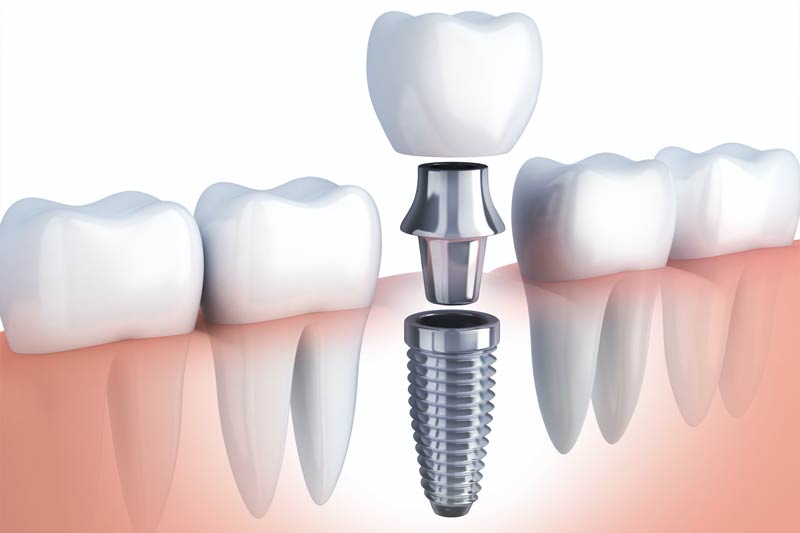 Implants Dentist in Los Angeles