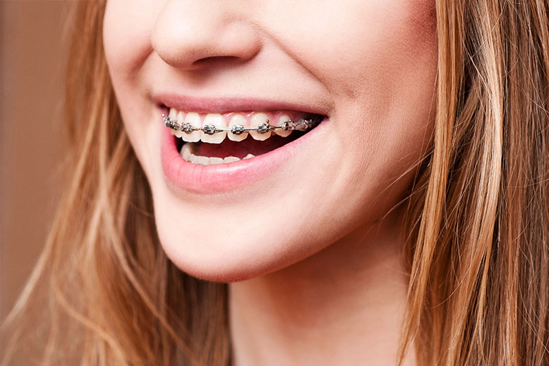 Orthodontics in Los Angeles