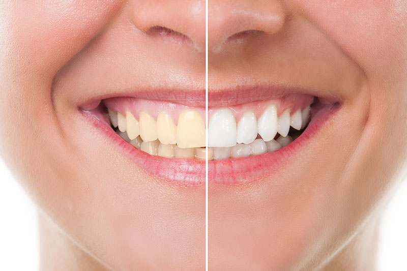 Teeth Whitening in Los Angeles